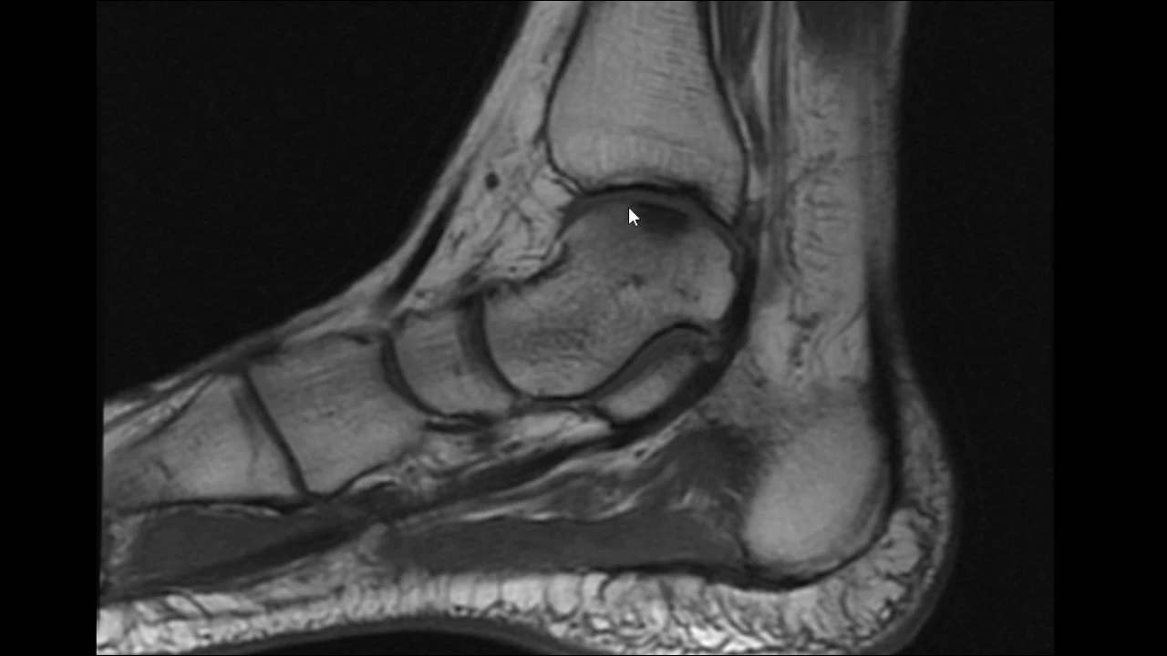 Talusta Osteokondral Lezyon Nedir? Talusta Osteokondral Lezyon Belirtileri