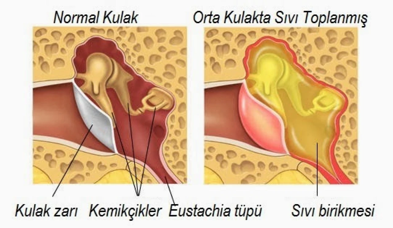 Kulakta Sıvı Birikmesi Nedir? Nedenleri ve Tedavi Yöntemleri