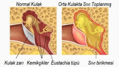 Kulakta Sıvı Birikmesi Nedir? Nedenleri ve Tedavi Yöntemleri